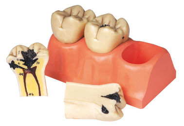 Dissected Human Teeth Model of Dental Disease For Internship And Students Training
